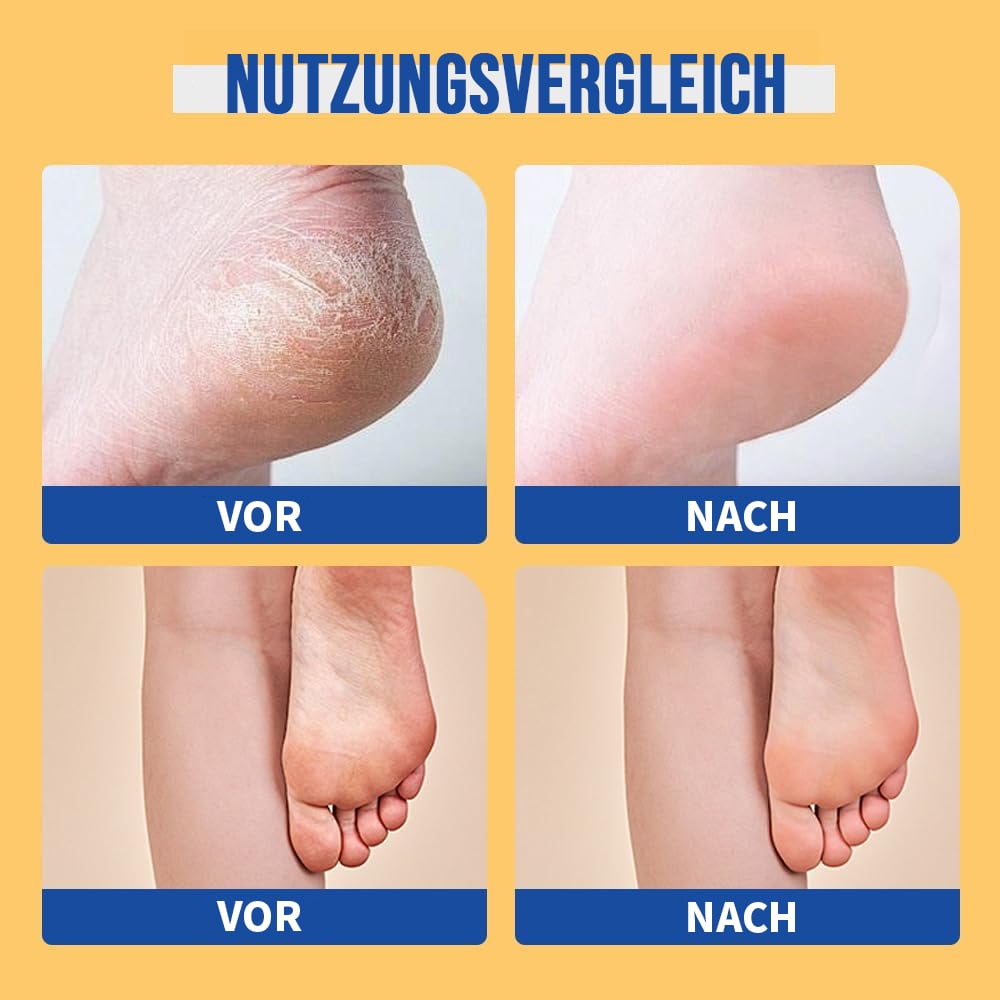 🔥LETZTER TAG 50 % RABATT & Feuchtigkeitsspendende und rissfreie Fußcreme